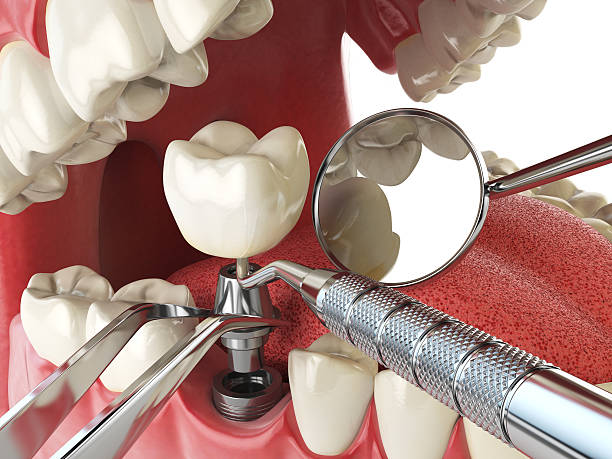 Best Lost Filling or Crown Replacement in Griffin, GA